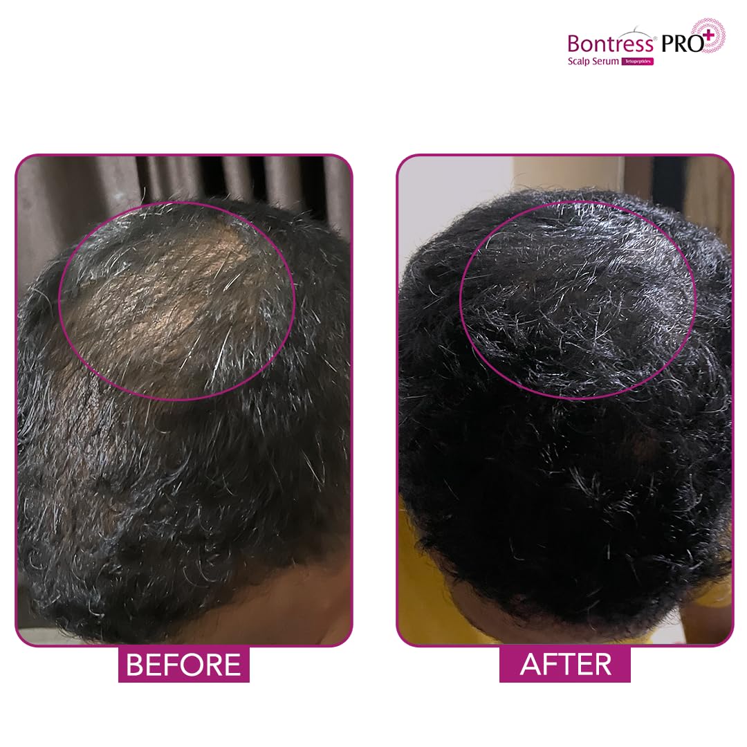 Bontress PRO+ Hair Growth Serum